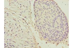 Immunohistochemistry of paraffin-embedded human cervical cancer using ABIN7157360 at dilution of 1:100 (Keratin 33B anticorps  (AA 1-404))