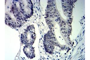 Immunohistochemical analysis of paraffin-embedded colon cancer tissues using CDKN1C mouse mAb with DAB staining.