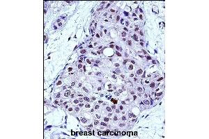MYB Antibody (Center) (ABIN657911 and ABIN2846859) immunohistochemistry analysis in formalin fixed and paraffin embedded human breast carcinoma followed by peroxidase conjugation of the secondary antibody and DAB staining. (MYB anticorps  (AA 419-448))