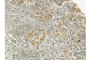 ABIN6258511 and ABIN6274725 at 1/100 staining human tongue carcinoma by IHC-P.