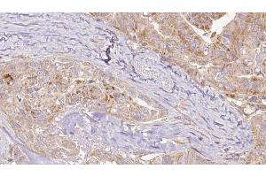 ABIN6267131 at 1/100 staining Human thyroid cancer tissue by IHC-P. (KIF1B anticorps  (pSer1487))