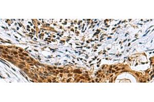 Immunohistochemistry of paraffin-embedded Human esophagus cancer tissue using NABP1 Polyclonal Antibody at dilution of 1:80(x200) (OBFC2A anticorps)