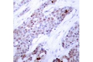 Immunohistochemistry of paraffin-embedded human breast carcinoma using Phospho-ATF4-S245 antibody (ABIN2987890). (ATF4 anticorps  (pSer245))