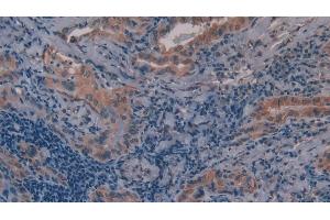 Detection of MMP11 in Human Thyroid cancer Tissue using Polyclonal Antibody to Matrix Metalloproteinase 11 (MMP11) (MMP11 anticorps  (AA 277-488))