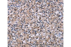 Immunohistochemistry of Human liver cancer using NR1D1 Polyclonal Antibody at dilution of 1:60 (NR1D1 anticorps)