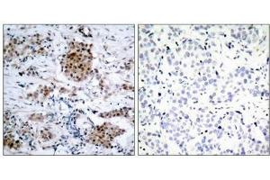 Immunohistochemical analysis of paraffin-embedded human breast carcinoma tissue using Estrogen Receptor-a(Phospho-Ser167) Antibody(left) or the same antibody preincubated with blocking peptide(right).