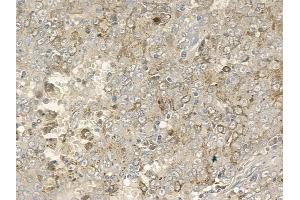 ABIN6256710 and ABIN6267163 at 1/100 staining human melanoma by IHC-P. (DLG2 anticorps  (pTyr340))