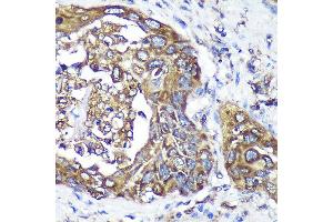 Immunohistochemistry of paraffin-embedded Human lung cancer using  Rabbit pAb (ABIN7265603) at dilution of 1:100 (40x lens). (ANKLE2 anticorps  (AA 350-450))