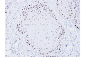 IHC-P Image Immunohistochemical analysis of paraffin-embedded Cal27 xenograft, using BLM, antibody at 1:100 dilution. (BLM anticorps  (C-Term))