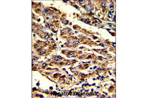 Formalin-fixed and paraffin-embedded human hepatocarcinoma with HOMER1 Antibody (N-term), which was peroxidase-conjugated to the secondary antibody, followed by DAB staining. (HOMER1 anticorps  (N-Term))