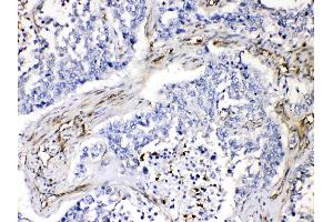 VASP was detected in paraffin-embedded sections of human lung cancer tissues using rabbit anti- VASP Antigen Affinity purified polyclonal antibody (Catalog # ) at 1 µg/mL. (VASP anticorps  (N-Term))