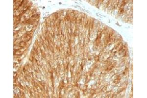 Formalin-fixed, paraffin-embedded human bladder carcinoma stained with Beta-2-Microglobulin antibody.