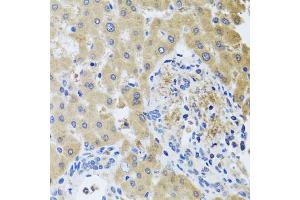 Immunohistochemistry of paraffin-embedded human liver injury using RHOB antibody (ABIN5975835) at dilution of 1/100 (40x lens). (RHOB anticorps)