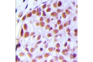 Immunohistochemical analysis of TAF5L staining in human breast cancer formalin fixed paraffin embedded tissue section. (TAF5L anticorps)
