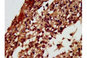 IHC image of ABIN7167616 diluted at 1:300 and staining in paraffin-embedded human melanoma performed on a Leica BondTM system.