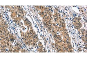 Immunohistochemistry of paraffin-embedded Human gastric cancer tissue using BNIP3L Polyclonal Antibody at dilution 1:40 (BNIP3L/NIX anticorps)