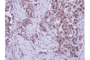 IHC-P Image Immunohistochemical analysis of paraffin-embedded human breast cancer, using MUSK, antibody at 1:250 dilution. (MUSK anticorps  (N-Term))