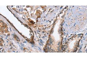 Immunohistochemistry of paraffin-embedded Human prostate cancer using MAD2L1BP Polyclonal Antibody at dilution of 1:65 (MAD2L1BP anticorps)