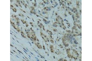 Immunohistochemistry of paraffin-embedded Human colon carcinoma using GABPA Polyclonal Antibody at dilution of 1:100 (40x lens).