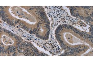 Immunohistochemistry of paraffin-embedded Human colon cancer using MCM3AP Polyclonal Antibody at dilution of 1:30 (GANP anticorps)