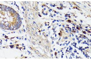 Immunohistochemistry of paraffin-embedded Human colon carcinoma using TREM2 Polyclonal Antibody at dilution of 1:200 (40x lens). (TREM2 anticorps)