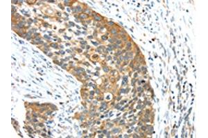 The image on the left is immunohistochemistry of paraffin-embedded Human esophagus cancer tissue using ABIN7131474(TRIM16 Antibody) at dilution 1/35, on the right is treated with fusion protein. (TRIM16 anticorps)