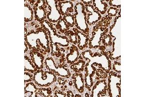 Immunohistochemical staining (Formalin-fixed paraffin-embedded sections) of human lactating breast with CSN2 polyclonal antibody  shows strong cytoplasmic positivity in glandular cells. (CSN2 anticorps)