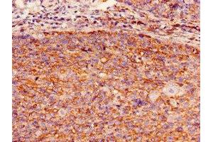 Immunohistochemistry of paraffin-embedded human pancreatic cancer using ABIN7154773 at dilution of 1:100 (GBP2 anticorps  (AA 100-259))