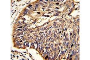 IHC analysis of FFPE human lung carcinoma stained with MyD88 antibody (MYD88 anticorps  (AA 136-164))