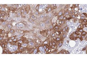ABIN6274028 at 1/100 staining Human Head and neck cancer tissue by IHC-P. (PD-1 anticorps  (Internal Region))
