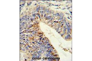 Formalin-fixed and paraffin-embedded human colon carcinoma reacted with ADAMDEC1 Antibody (N-term), which was peroxidase-conjugated to the secondary antibody, followed by DAB staining. (ADAMDEC1 anticorps  (N-Term))