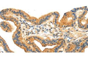 Immunohistochemistry of paraffin-embedded Human thyroid cancer tissue using RRAGA Polyclonal Antibody at dilution 1:30 (RRAGA anticorps)