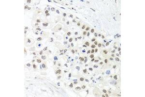 Immunohistochemistry of paraffin-embedded human lung cancer using TRMT1 antibody at dilution of 1:100 (x40 lens). (TRMT1 anticorps)