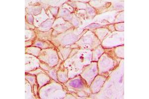 Immunohistochemical analysis of ARALAR1 staining in human breast cancer formalin fixed paraffin embedded tissue section. (SLC25A12 anticorps  (Center))