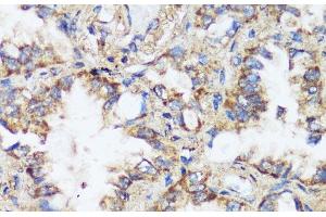 Immunohistochemistry of paraffin-embedded Human lung cancer using ERK1 / ERK2 Polyclonal Antibody at dilution of 1:200 (40x lens). (ERK1/2 anticorps)