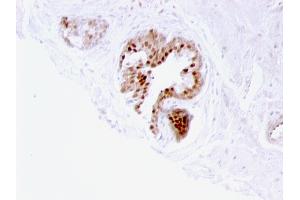 Formalin-fixed, paraffin-embedded human Prostate Carcinoma stained with p57 Mouse Monoclonal Antibody (57P06). (CDKN1C anticorps)