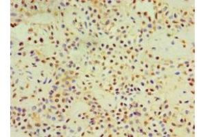Immunohistochemistry of paraffin-embedded human breast cancer using ABIN7149492 at dilution of 1:100 (DACT3 anticorps  (AA 1-160))