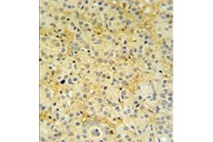 Formalin fixed, paraffin embedded prostate carcinoma stained with DAZAP2 Antibody (C-term) followed by peroxidase conjugation of the secondary antibody and DAB staining. (DAZAP2 anticorps  (C-Term))