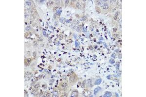 Immunohistochemistry of paraffin-embedded human liver cancer using FANCC antibody (ABIN3022593, ABIN3022594, ABIN3022595 and ABIN6218931) at dilution of 1:100 (40x lens).