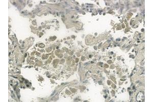 ABIN6259199 and ABIN6274305 at 1/100 staining human lung squamous cell carcinoma by IHC-P. (SSBP2 anticorps  (N-Term))