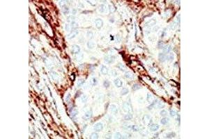 IHC analysis of FFPE human breast carcinoma tissue stained with the FGFR1 antibody (FGFR1 anticorps  (AA 19-48))