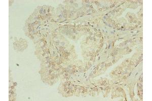 Immunohistochemistry of paraffin-embedded human prostate cancer using ABIN7155120 at dilution of 1:100 (HNRNPL anticorps  (AA 89-335))