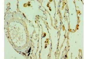 Immunohistochemistry of paraffin-embedded human lung cancer using ABIN7171841 at dilution of 1:100 (CLEC3B anticorps  (AA 22-202))