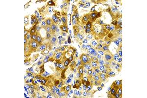 Immunohistochemistry of paraffin-embedded human liver cancer using CDK20 antibody (ABIN5971446) at dilution of 1/100 (40x lens).