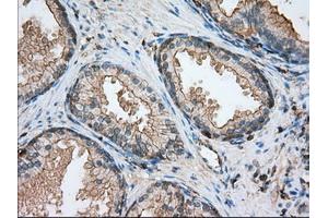 Immunohistochemical staining of paraffin-embedded Adenocarcinoma of ovary tissue using anti-ALDH3A1 mouse monoclonal antibody. (ALDH3A1 anticorps)