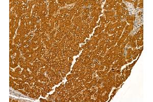 ABIN7094469 and ABIN7098517 at 1/100 staining Human liver cancer and adjacent normal tissues by IHC-P.