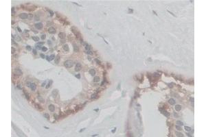 Detection of CF6 in Human Breast cancer Tissue using Polyclonal Antibody to Coupling Factor 6 (CF6)