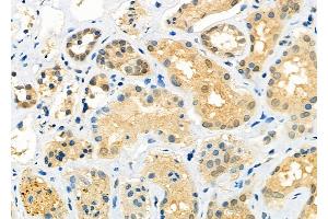 ABIN6260357 and ABIN6273203 at 1/100 staining Human kidney cancer and adjacent normal tissues by IHC-P. (C14orf166 anticorps)