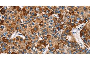 Immunohistochemistry of paraffin-embedded Human liver cancer tissue using SLAMF8 Polyclonal Antibody at dilution 1:40 (SLAMF8 anticorps)
