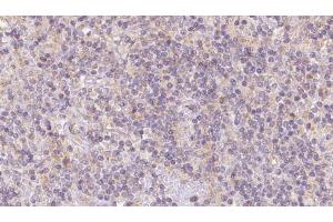 ABIN6273103 at 1/100 staining Human lymph cancer tissue by IHC-P. (Coq7 anticorps  (Internal Region))